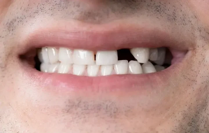 Dientes perdidos