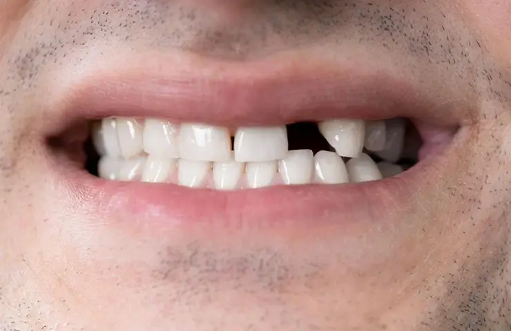 Dientes perdidos