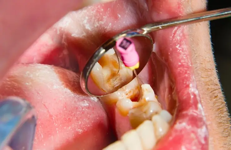 Empastes dentales