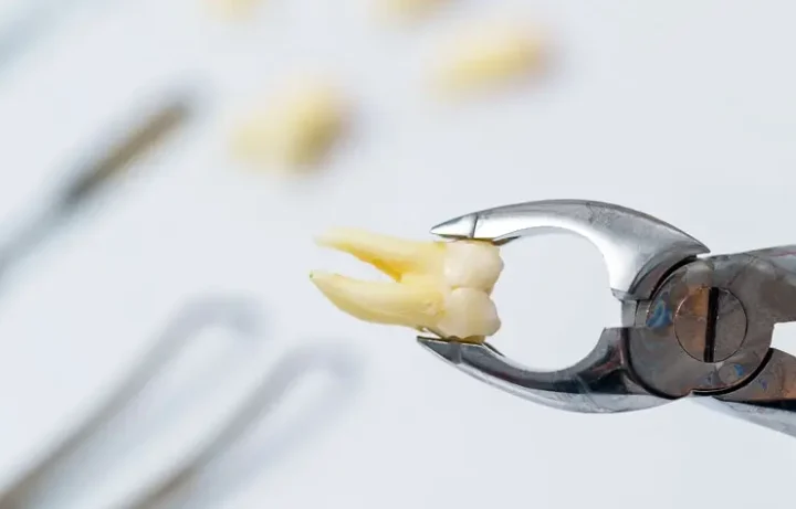 Extracción dental