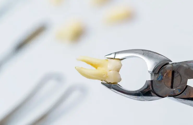 Extracción dental
