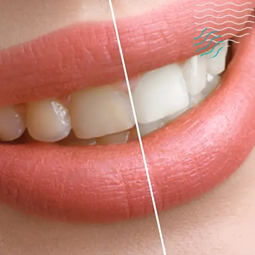 Blanqueamiento dental