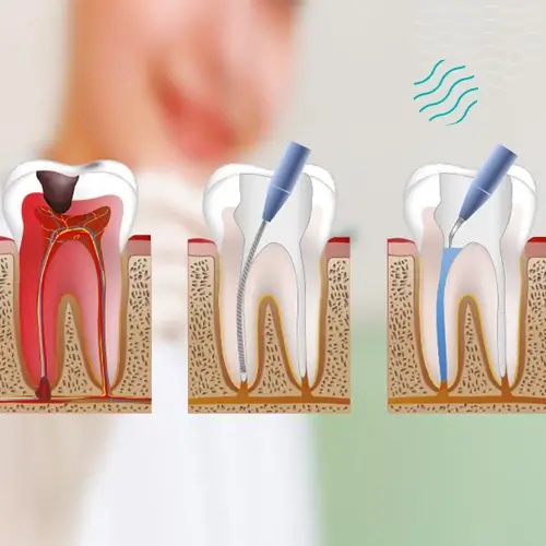 Endodoncia