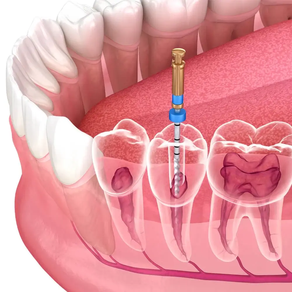 precio y ventajas de la endodoncia