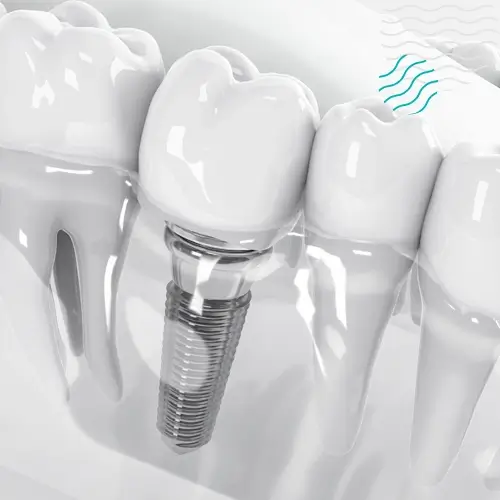 Implante dental