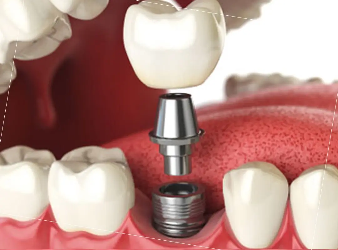 implante dental unitario