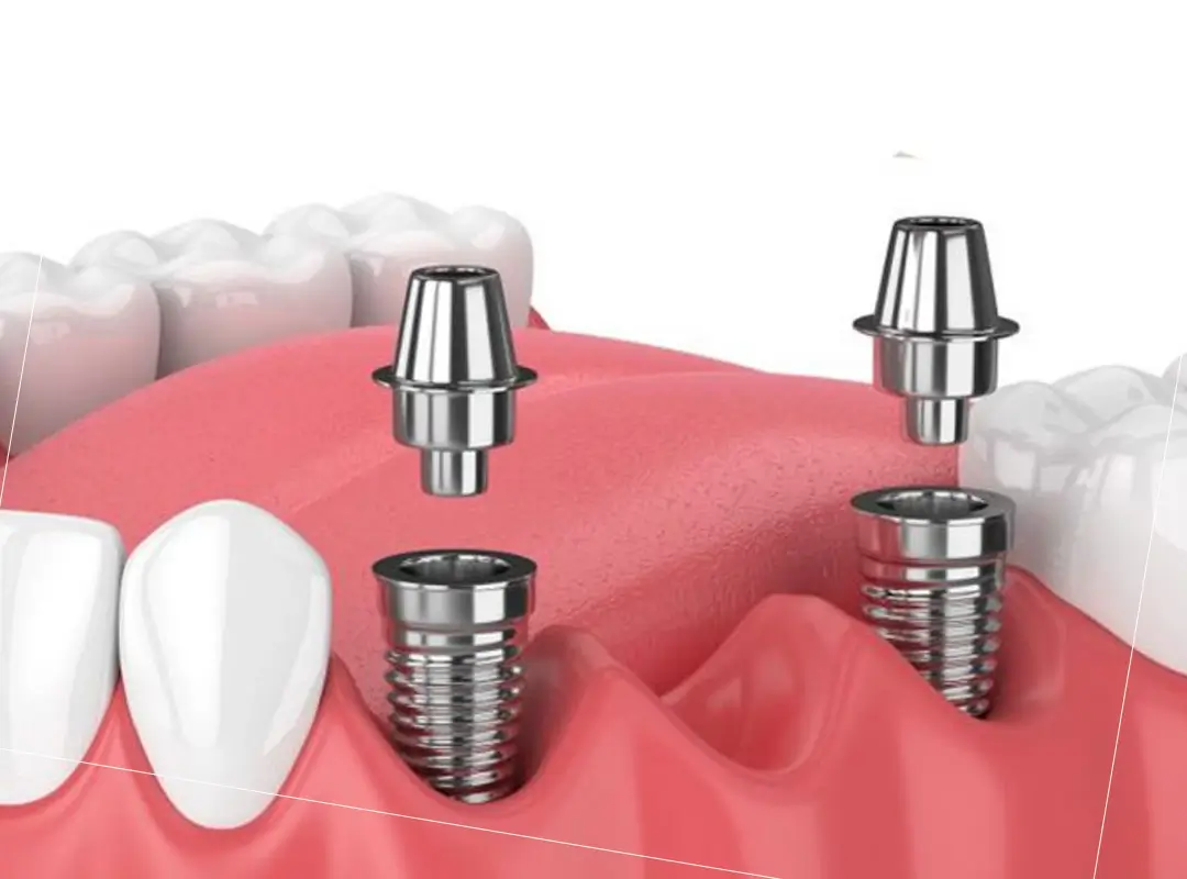 puente sobre varios implantes