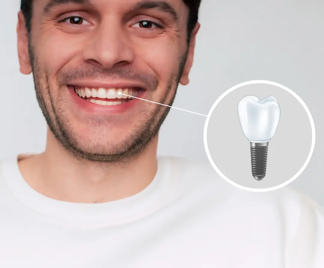 implante dental sonrisa