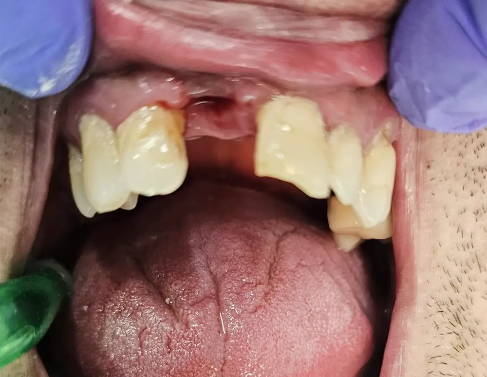 Paciente antes de tratamiento clínica dental Qident