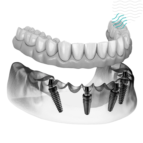 Prótesis dental