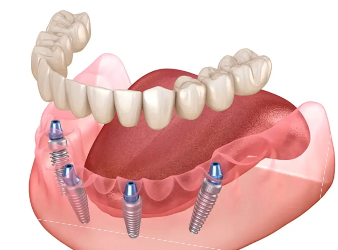 protesis sobre implantes