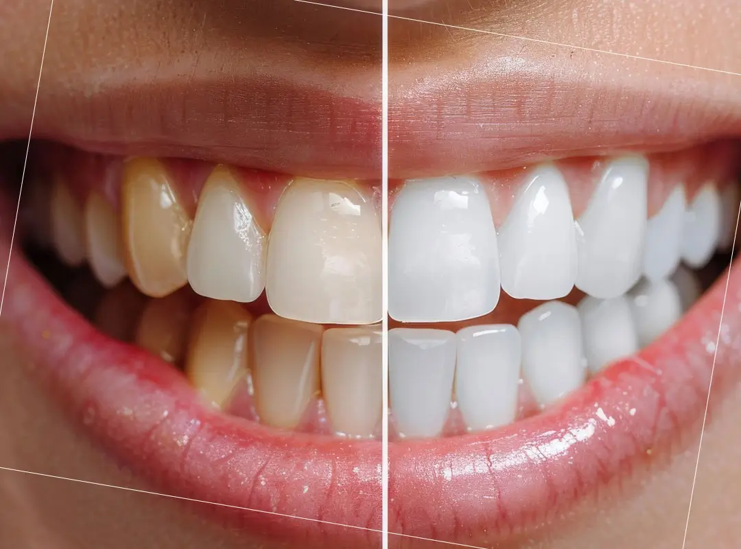 tratamiento de blanqueamiento dental